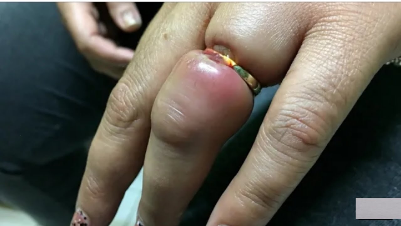 Desi Jugaad : उंगली में फंसी अंगूठी निकालने का अब तक का सबसे आसान तरीका, देखे वायरल वीडियो